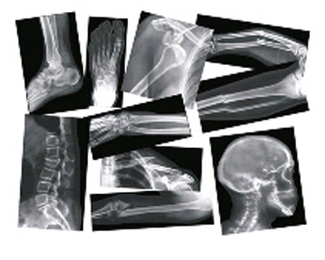 Picture of Broken bones x-rays