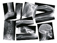 Broken bones x-rays